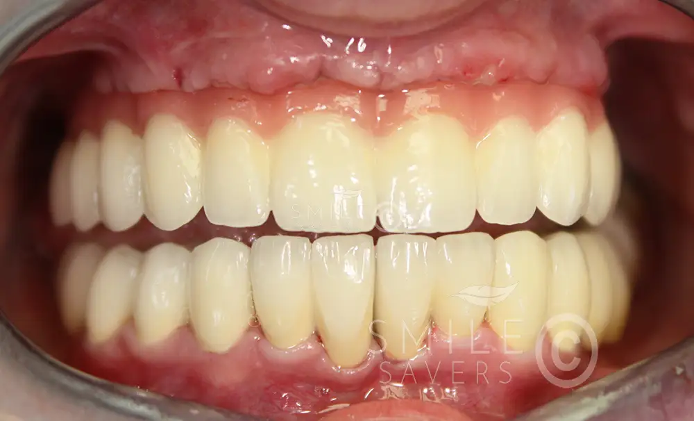 Additional photograph for All-on-6 implants in the upper jaw, lower single implants and dental crowns