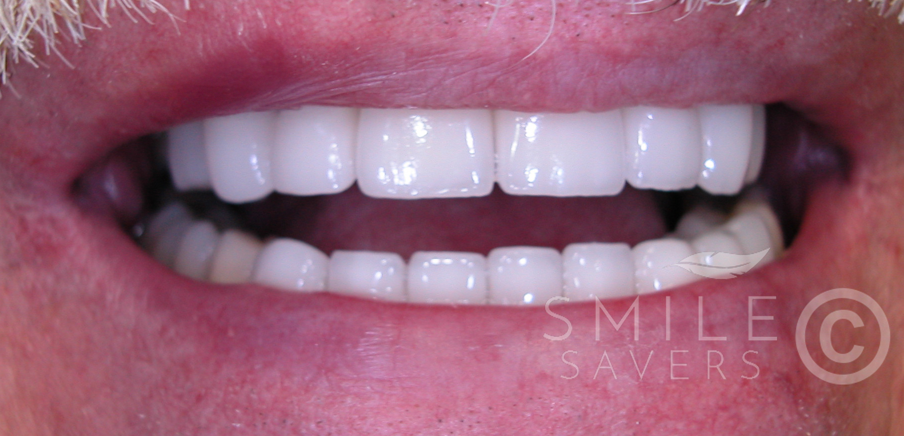 After treatment: Cosmetic Smile Makeover