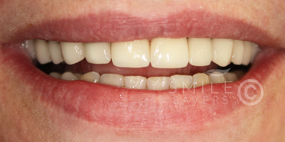 After treatment: Full-Mouth Makeover for Tooth Discolouration & Worn Teeth