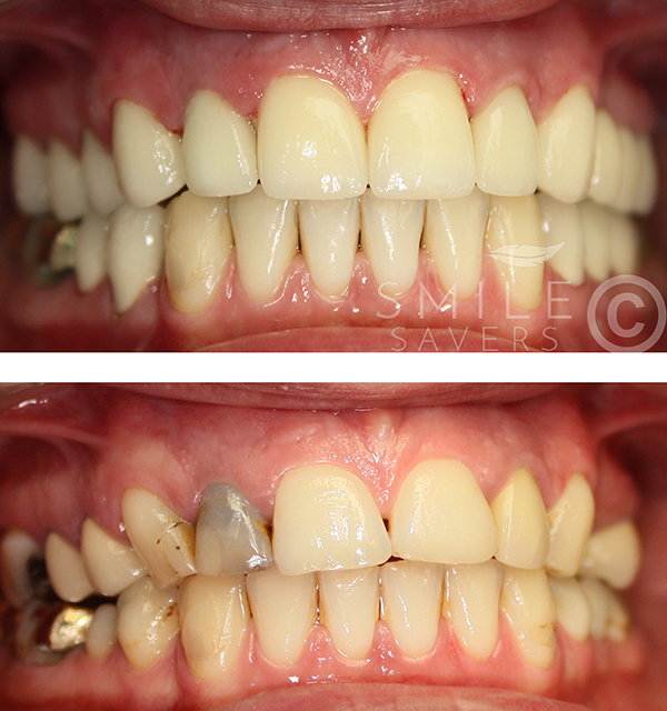 Additional photograph for Full-Mouth Makeover for Tooth Discolouration & Worn Teeth