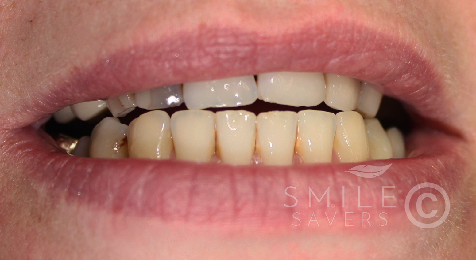 Before treatment: Full-Mouth Makeover for Tooth Discolouration & Worn Teeth
