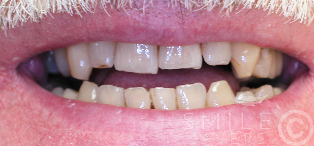 Before treatment: Cosmetic Smile Makeover