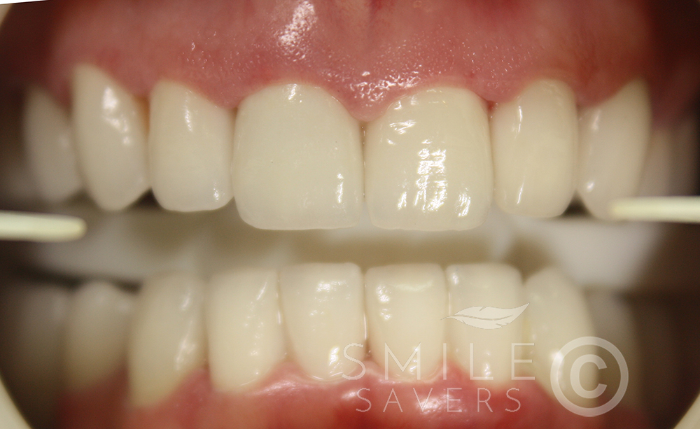 After treatment: Zirconium Smie Makeover and Dental Implants