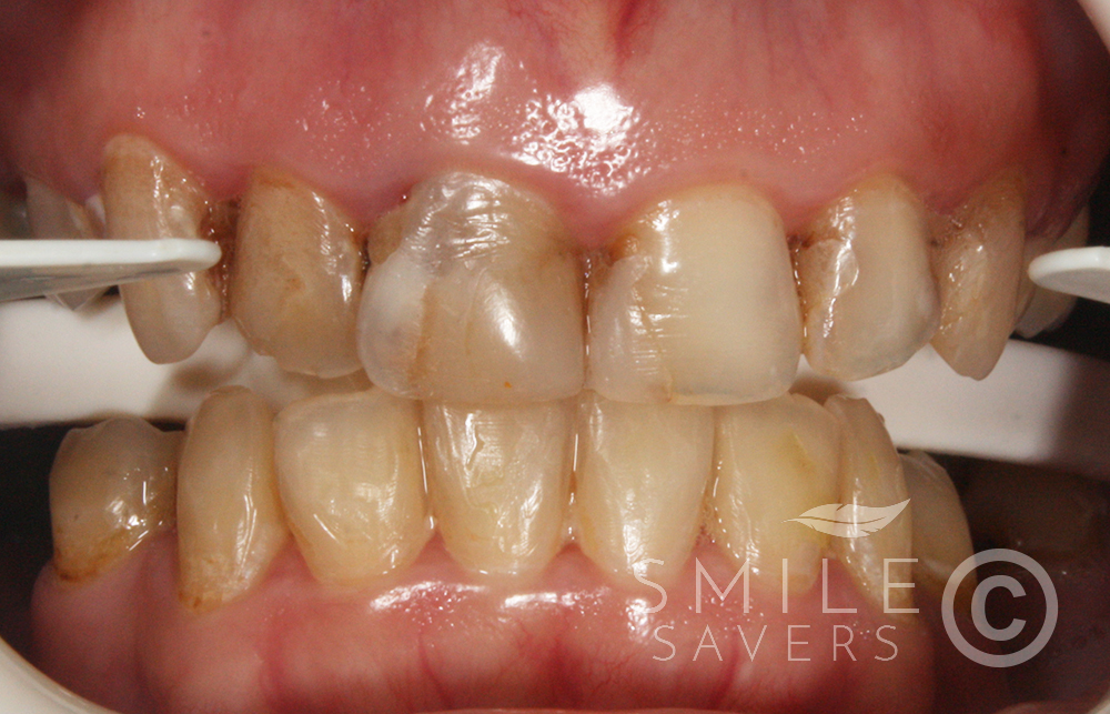 Before treatment: Zirconium Smie Makeover and Dental Implants