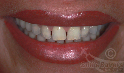 Before treatment: Smile Makeover with Zircon Crowns
