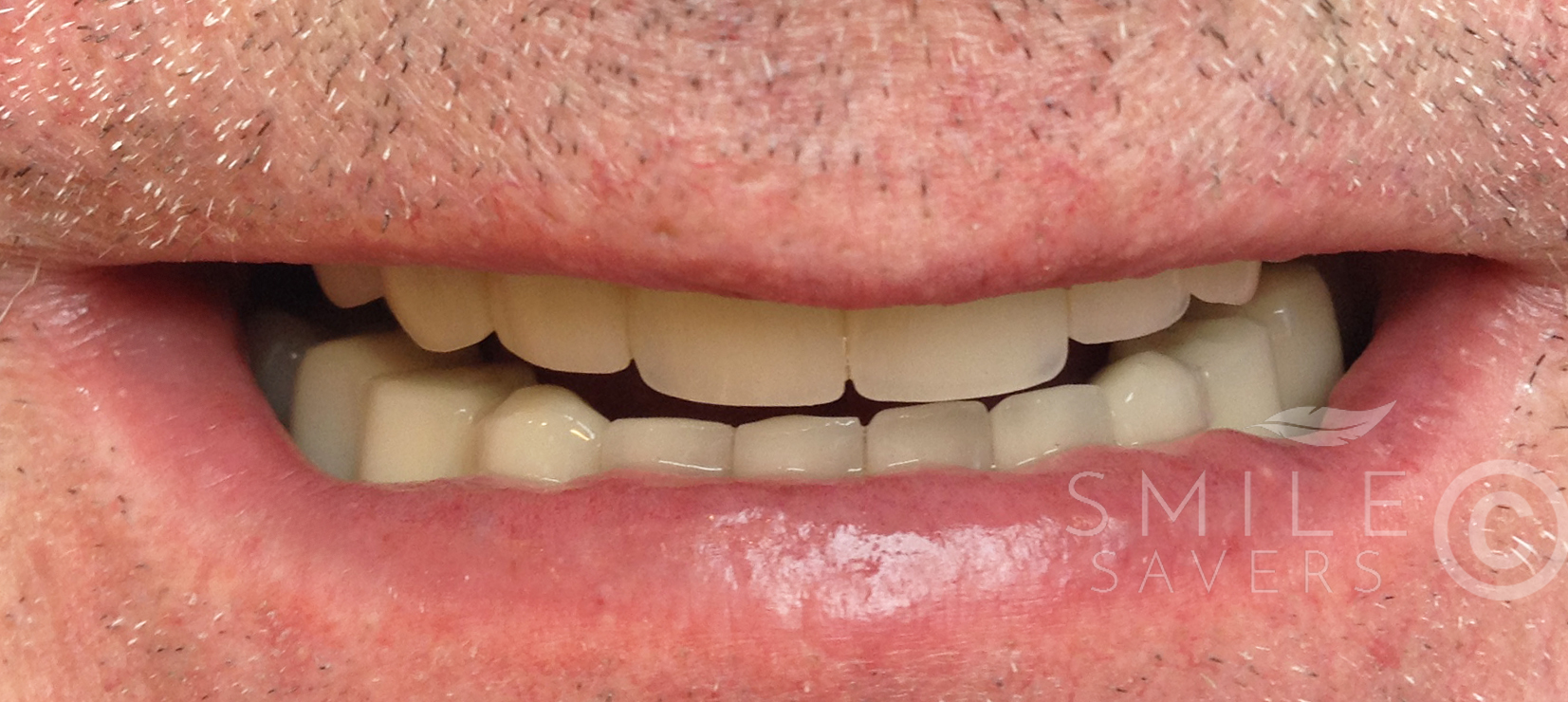 After treatment: Smile Makeover With Dental Crowns and Dental Implants