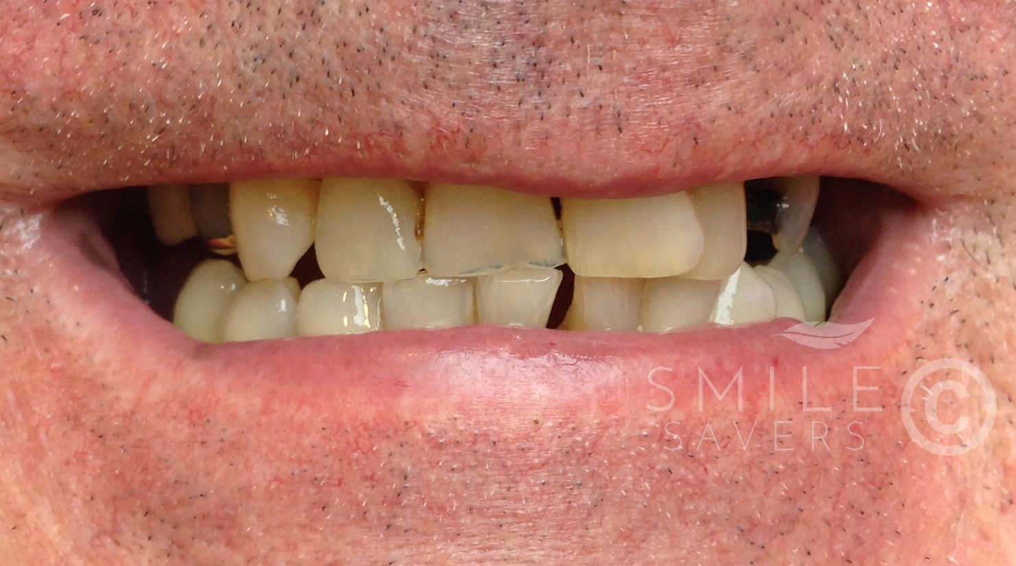 Before treatment: Smile Makeover With Dental Crowns and Dental Implants