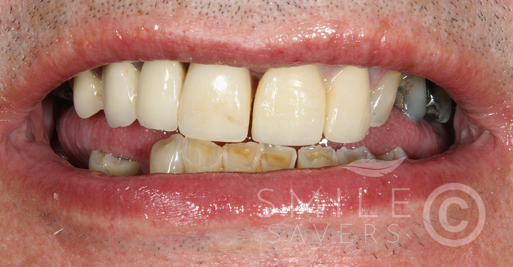 Before treatment: Porcelain bonded bridges